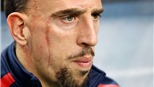 Franck Ribery: Quả bóng vàng không cần vết sẹo