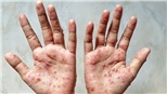 WHO xem xét khả năng ban bố tình trạng khẩn cấp y tế toàn cầu đối với bệnh đậu mùa khỉ