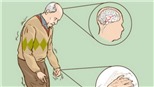 Các nhà khoa học Bỉ giải mã thành công bệnh Parkinson
