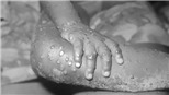 WHO bỏ phân loại quốc gia bệnh đặc hữu với đậu mùa khỉ