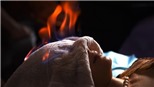Sử dụng 'hỏa trị liệu' để làm đẹp liệu có an toàn?