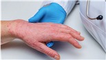 Thế giới nâng cao cảnh giác với bệnh đậu mùa khỉ