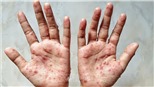 WHO kêu gọi công chúng hỗ trợ đổi tên bệnh đậu mùa khỉ